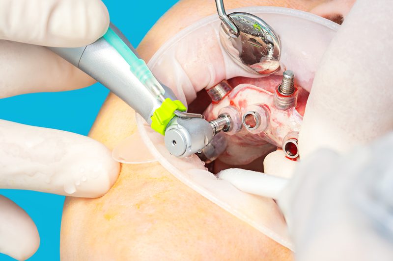 Surgical implant guide — 3D printed dental guide Sydney